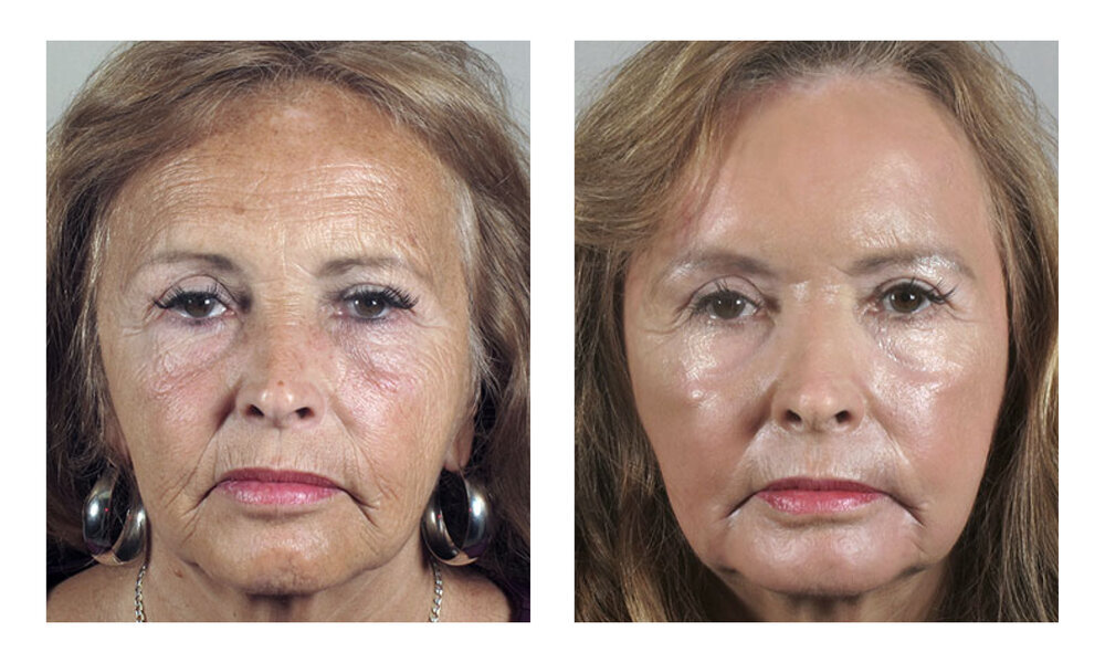 Chemical peel results