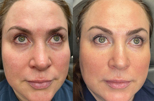 Under eye PRP treatment