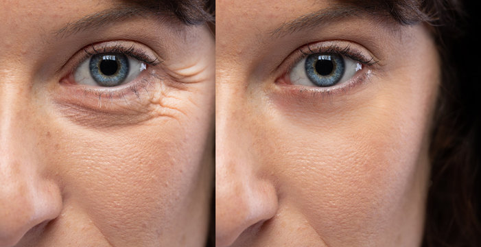 Skin rejuvenation results