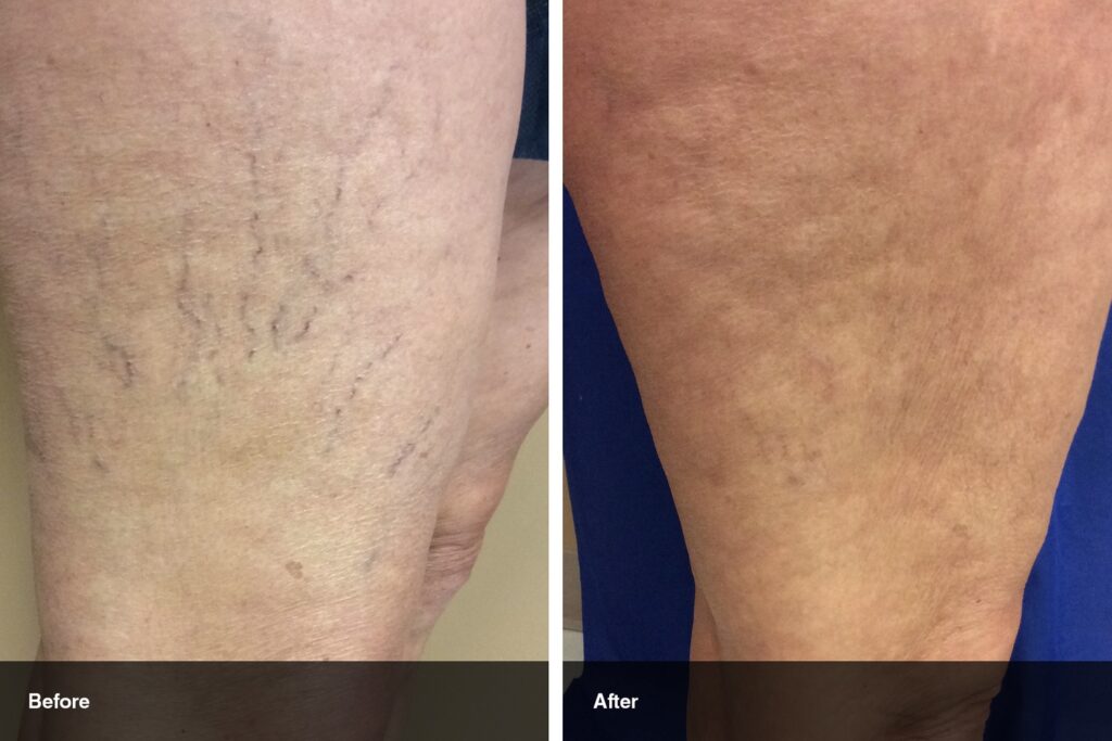 Spider Vein Treatment