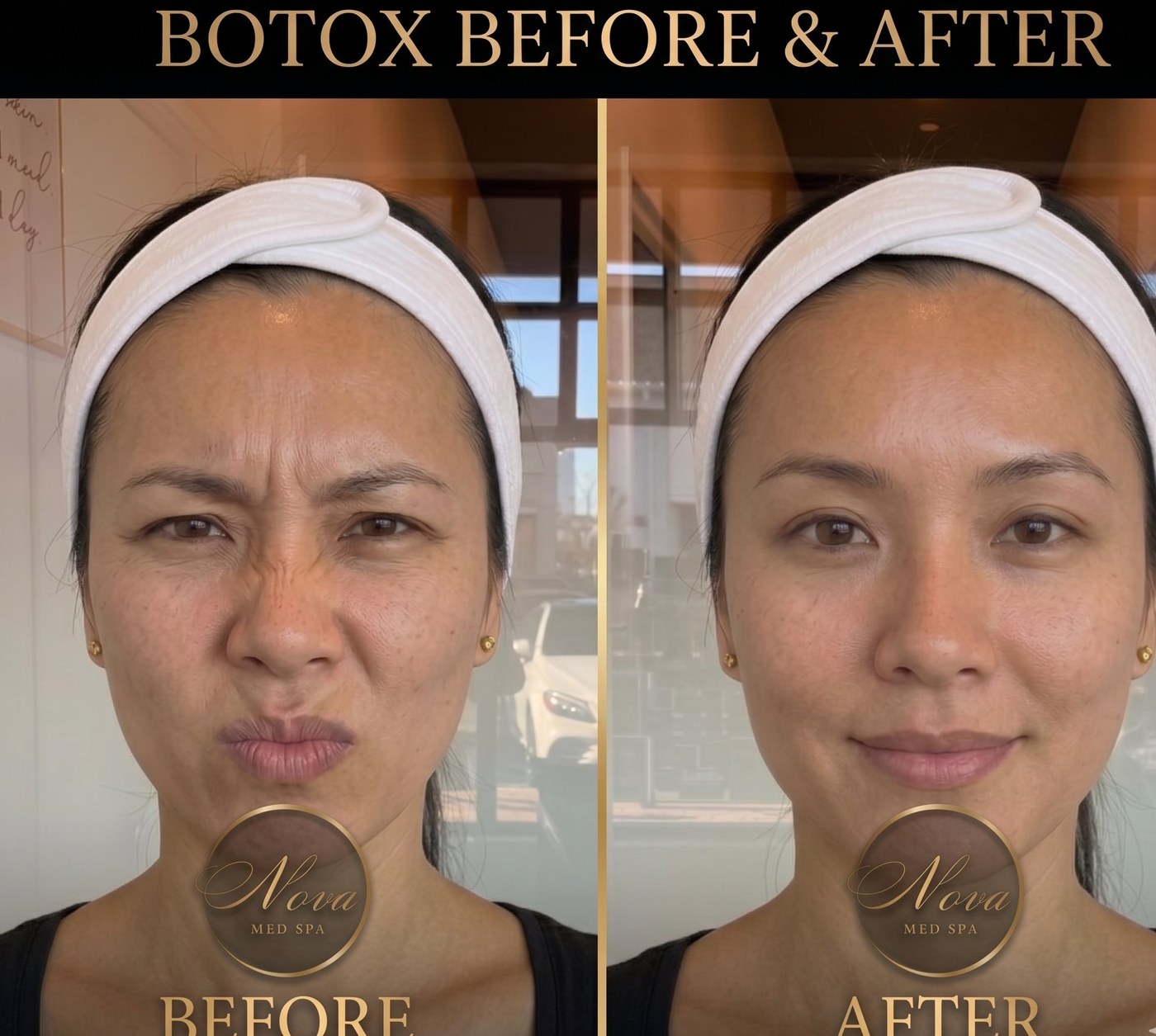 Botox frown lines result