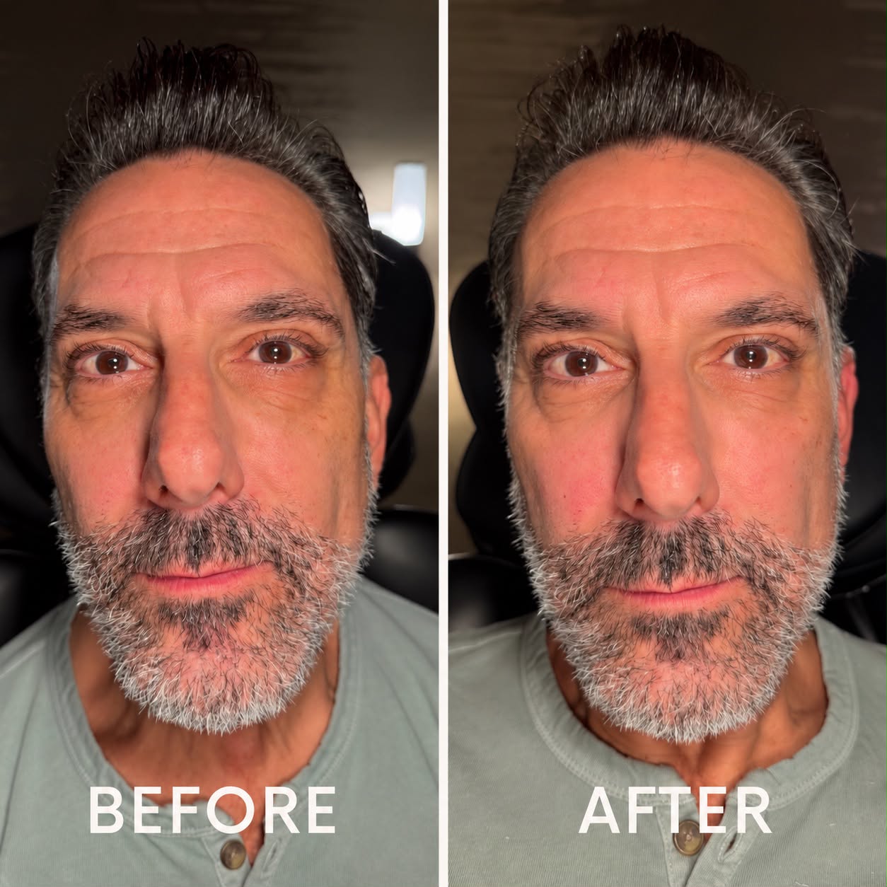 Men's Botox before and after - forehead lines and crow's feet at Nova Med Spa