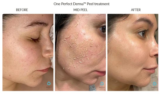 Microneedling series result - skin rejuvenation