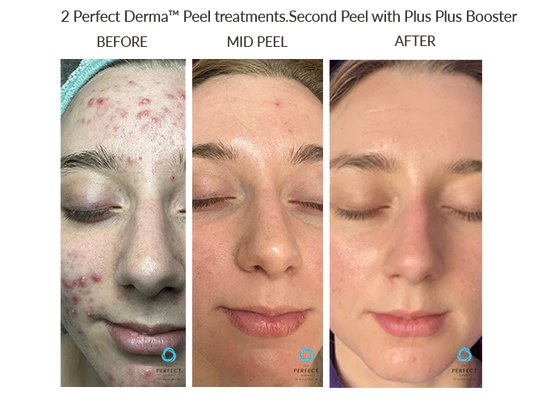 Chemical peel results for acne - Nova Med Spa Plainview NY
