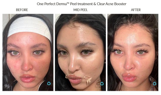 Chemical peel for acne and skin clarity - Nova Med Spa Plainview NY