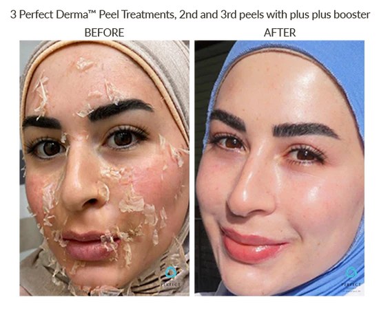 Sun damage laser treatment result
