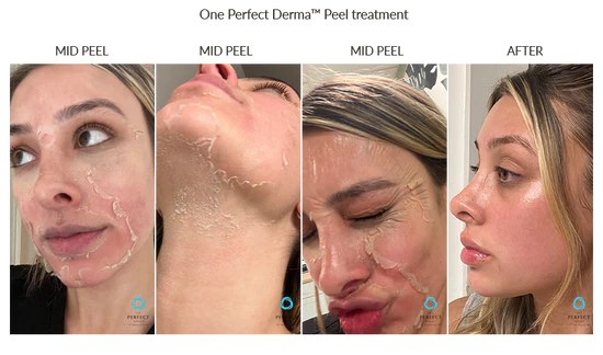 Chemical peel mid-peel process - Nova Med Spa Plainview NY