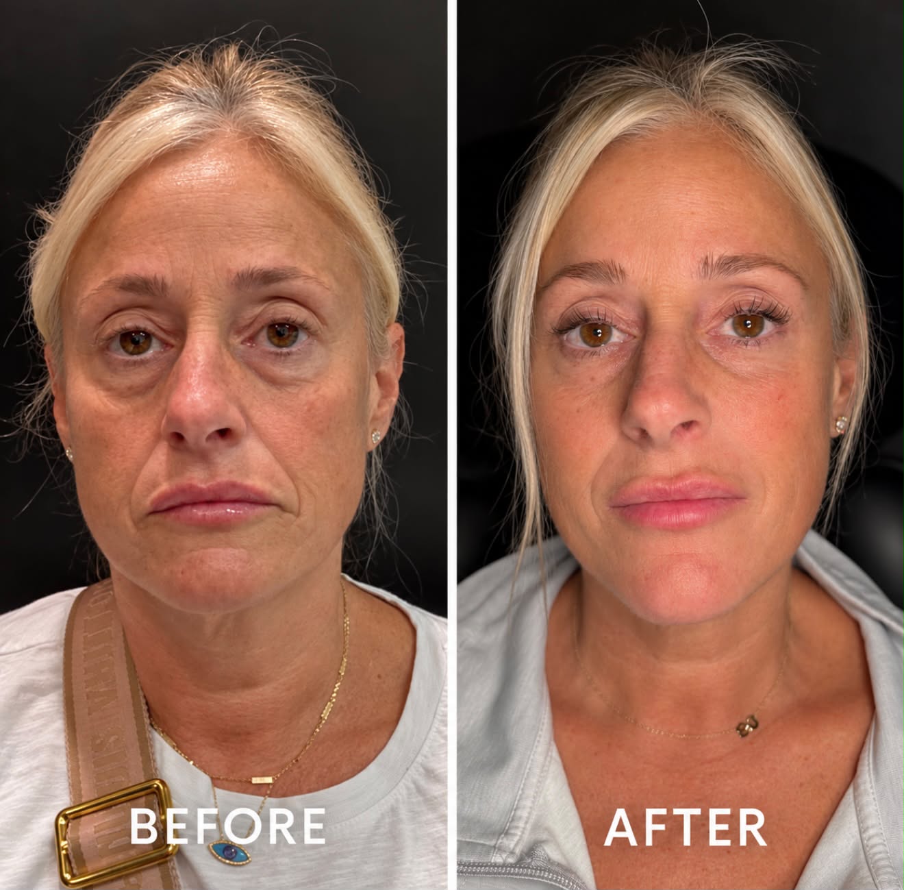 Dermal fillers full-face rejuvenation before and after at Nova Med Spa