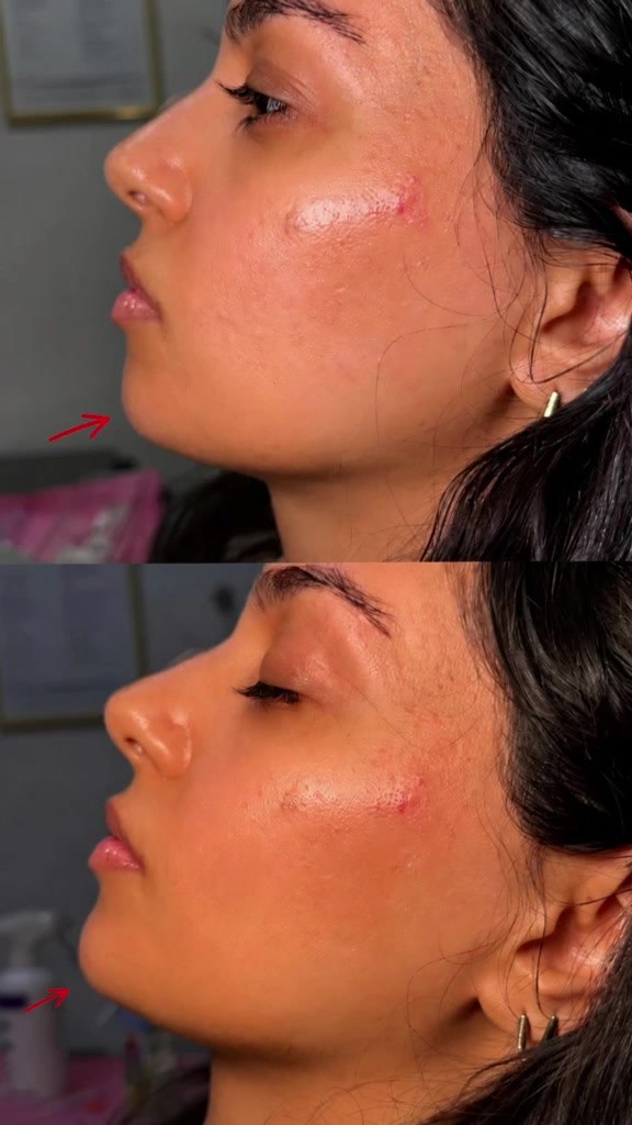 Dermal Fillers Before and After - chin enhancement at Nova Med Spa Plainview NY