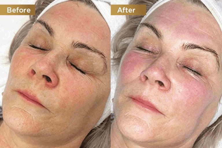 Hydra Treatment Before and After - deep hydration - Nova Med Spa Plainview NY