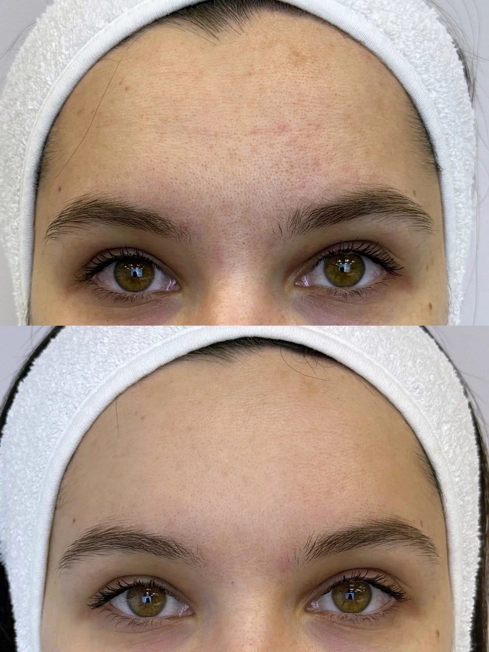 Laser resurfacing face + neck result - skin tightening