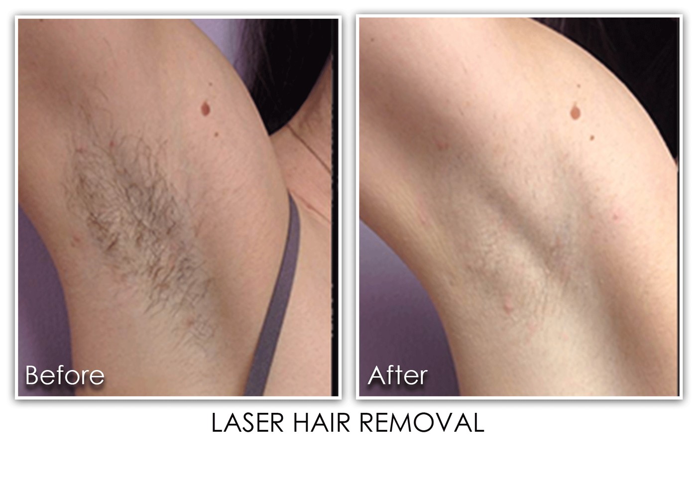Laser Hair Removal Before and After - Underarms result at Nova Med Spa Plainview NY