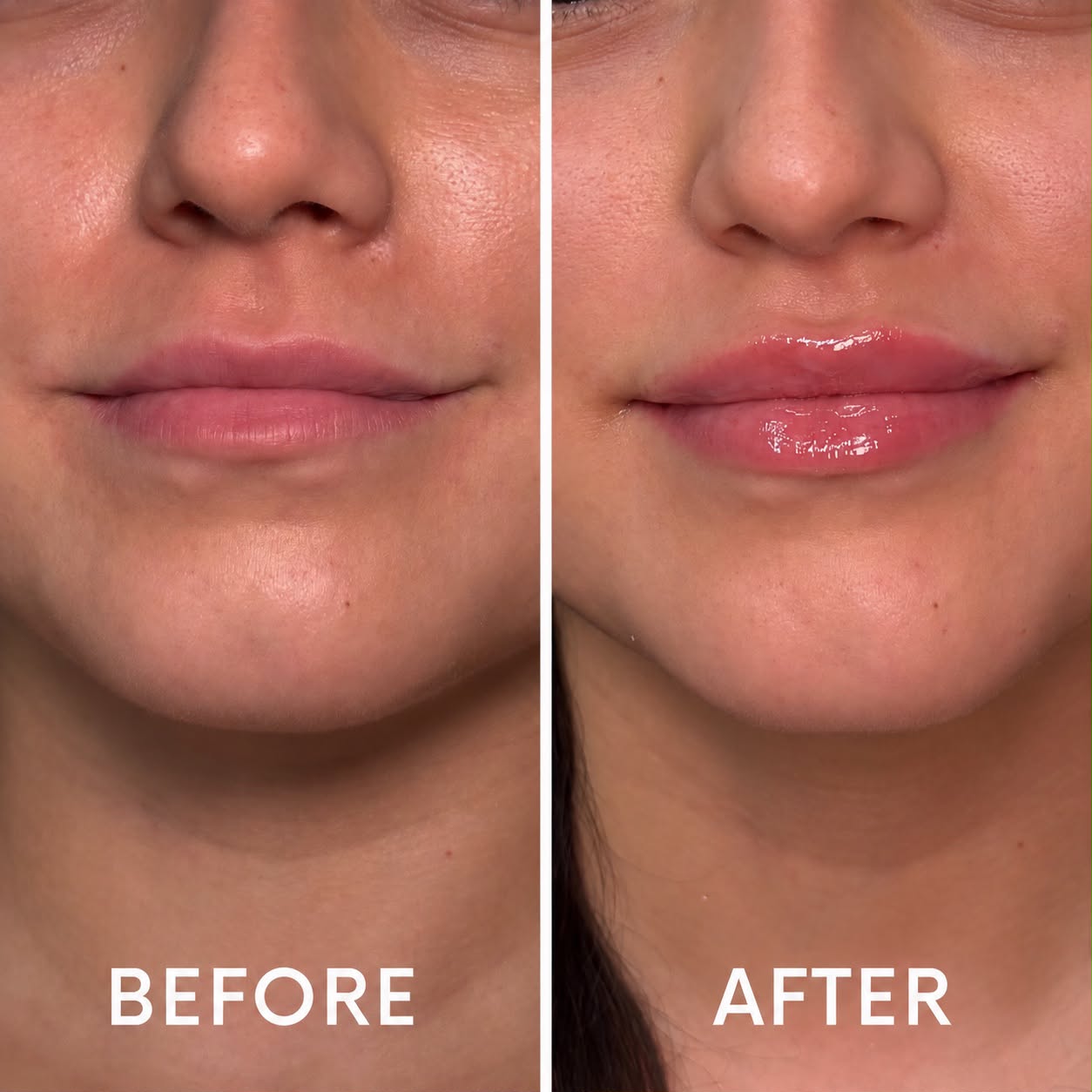 Lip filler before and after - soft hydrated pout at Nova Med Spa
