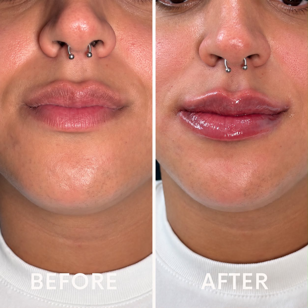 Lip filler before and after - bold volume at Nova Med Spa