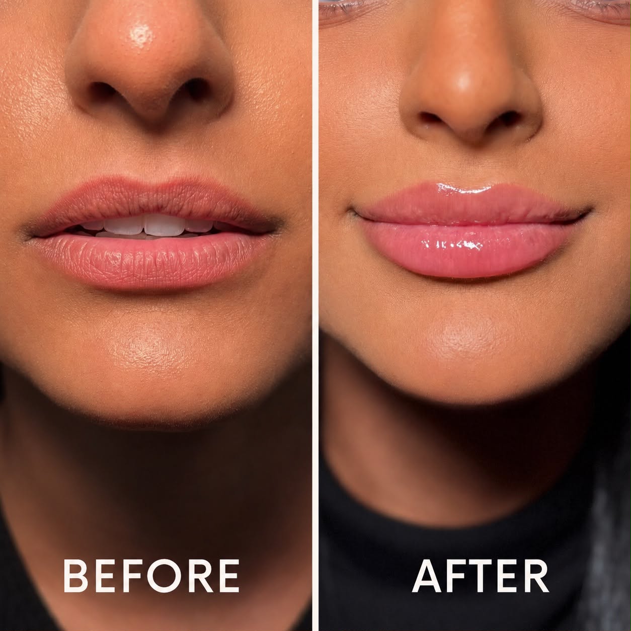 Lip filler before and after at Nova Med Spa