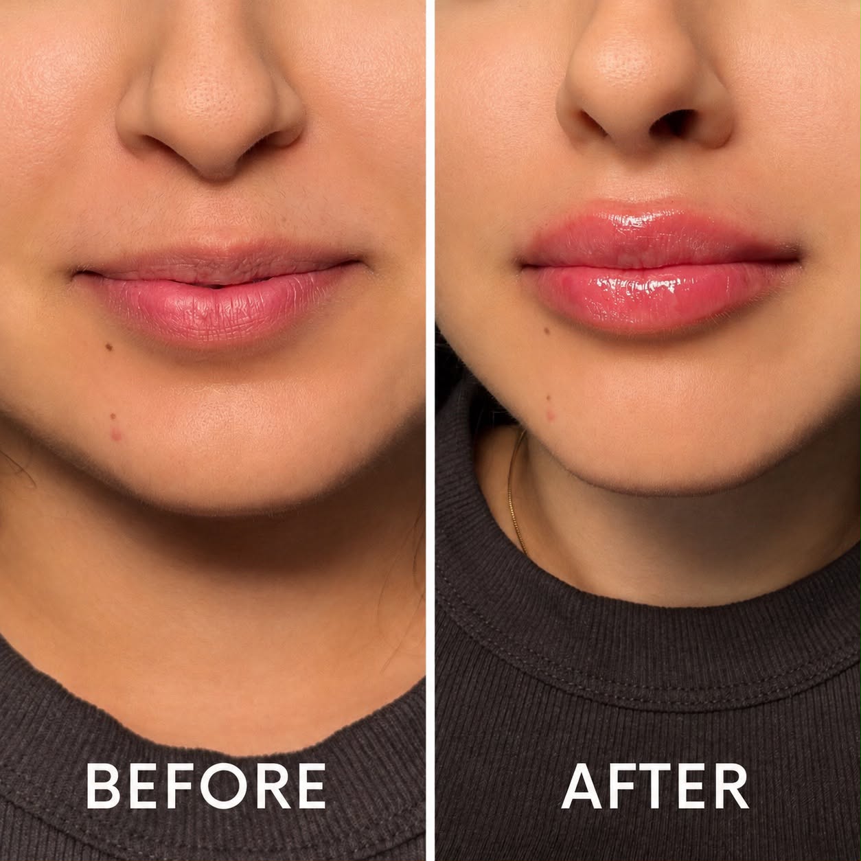 Lip filler before and after - plump defined lips at Nova Med Spa