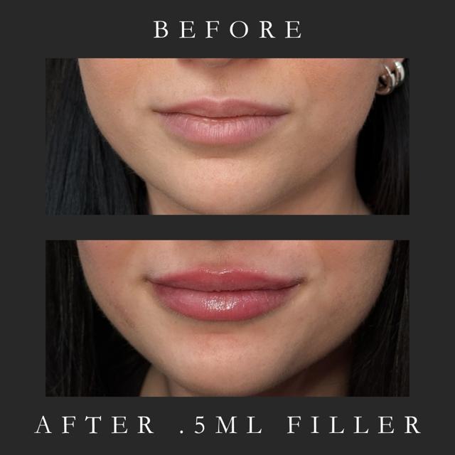 Lip Filler Before and After - 0.5ml natural enhancement