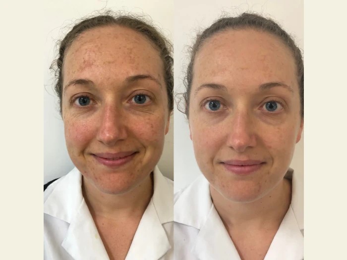 Melasma treatment Long Island NY