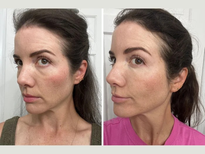 PRP Injections Before and After at Nova Med Spa Plainview NY