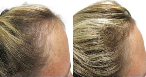 PRP Hair Restoration for women - thinning Before and After at Nova Med Spa