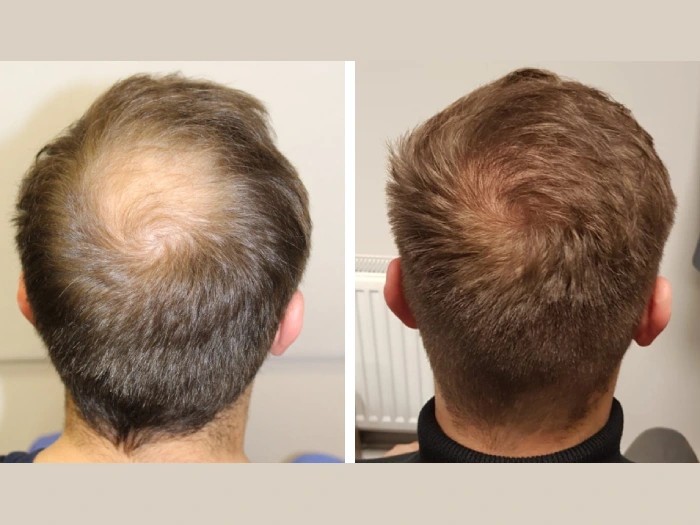PRP Hair Restoration Before and After at Nova Med Spa Plainview NY
