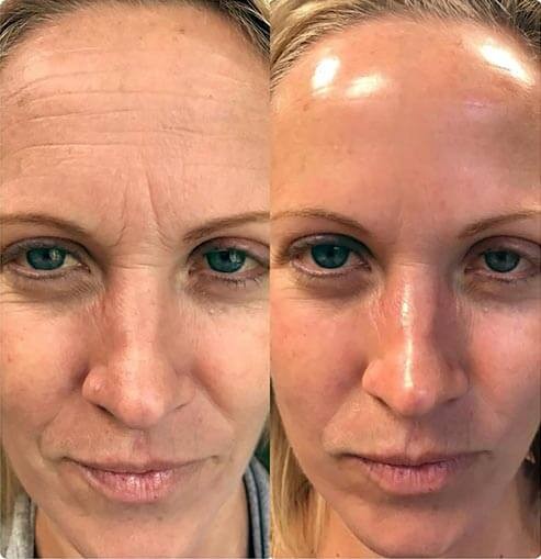 Red Carpet Glow Facial Before and After at Nova Med Spa Plainview NY