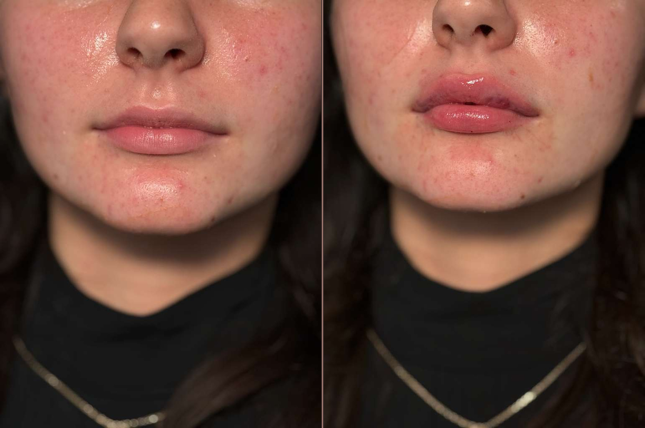 Close-up lip filler result