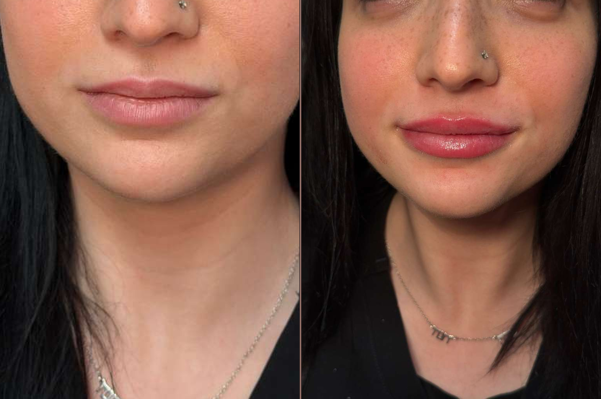 Lip filler shape result
