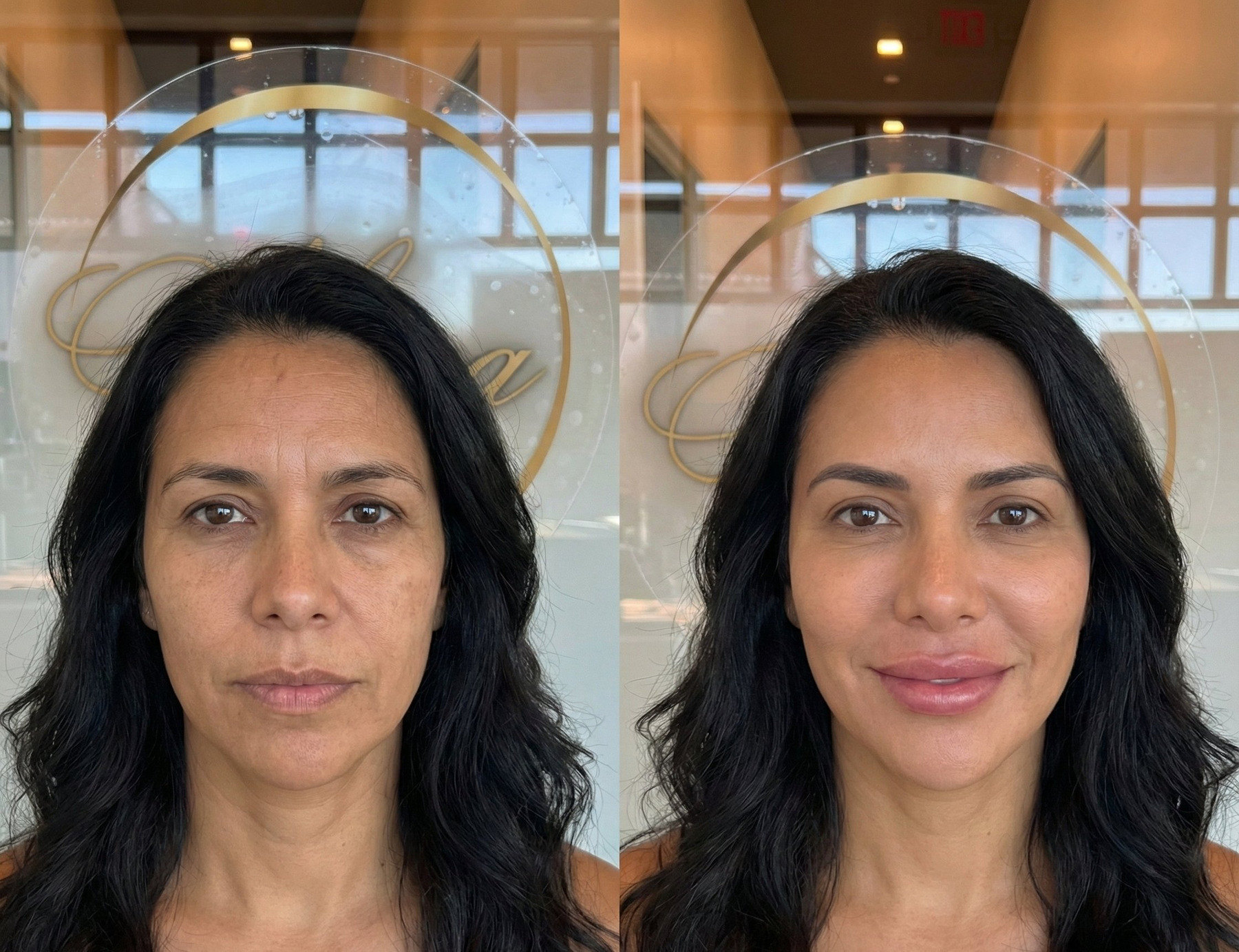 Mature lip rejuvenation