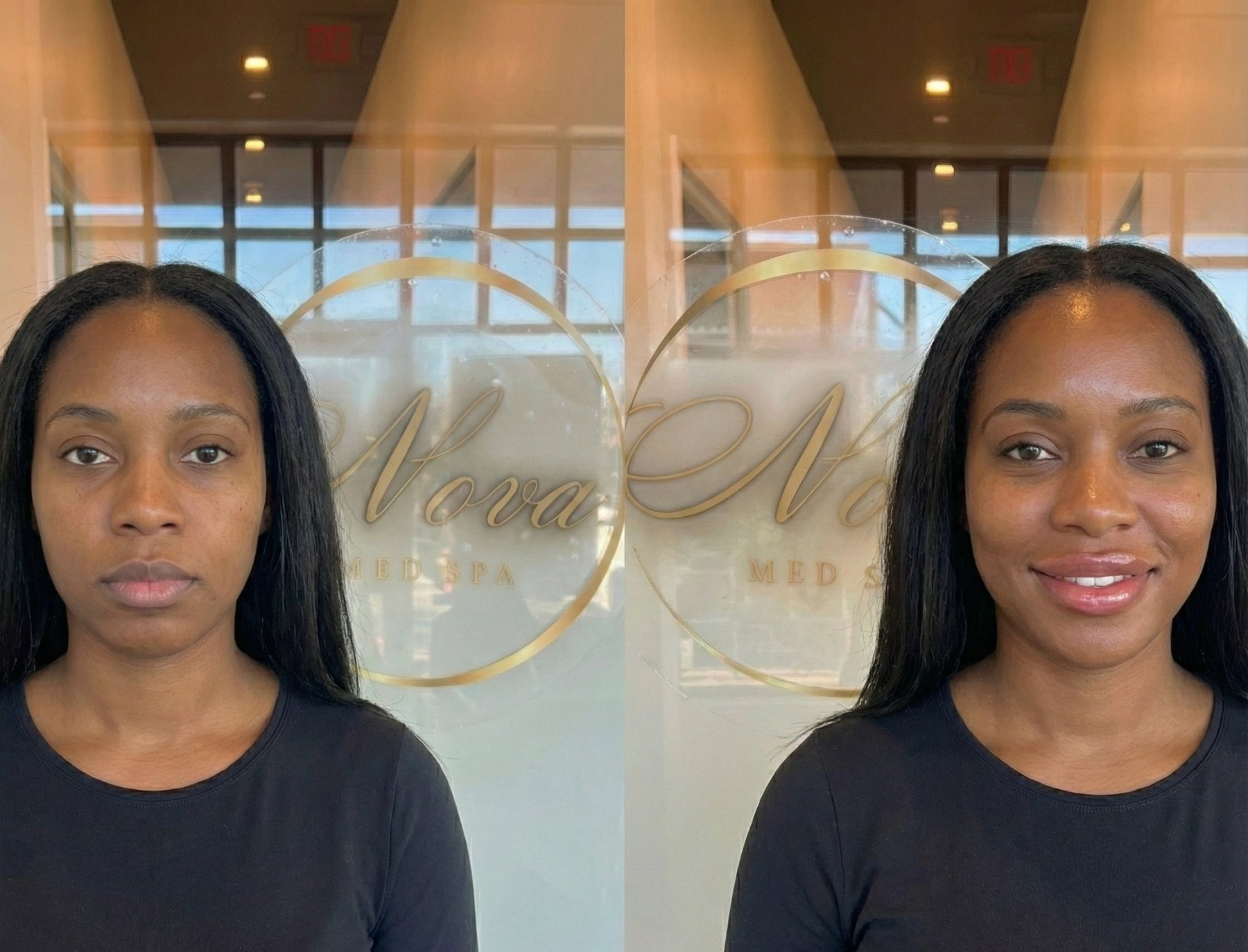 Natural lip filler enhancement