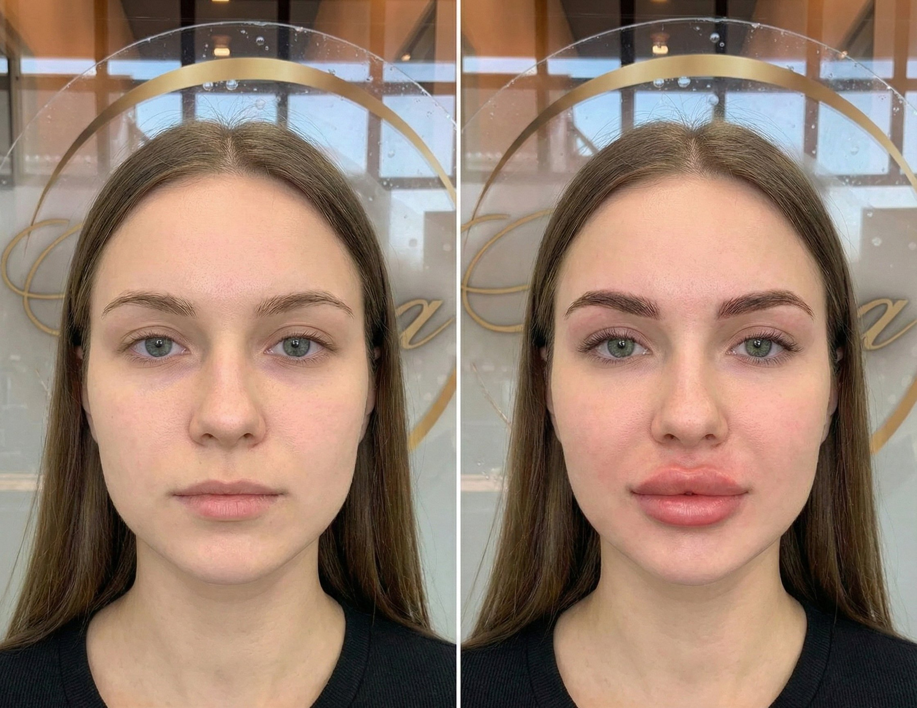 Russian lip filler technique