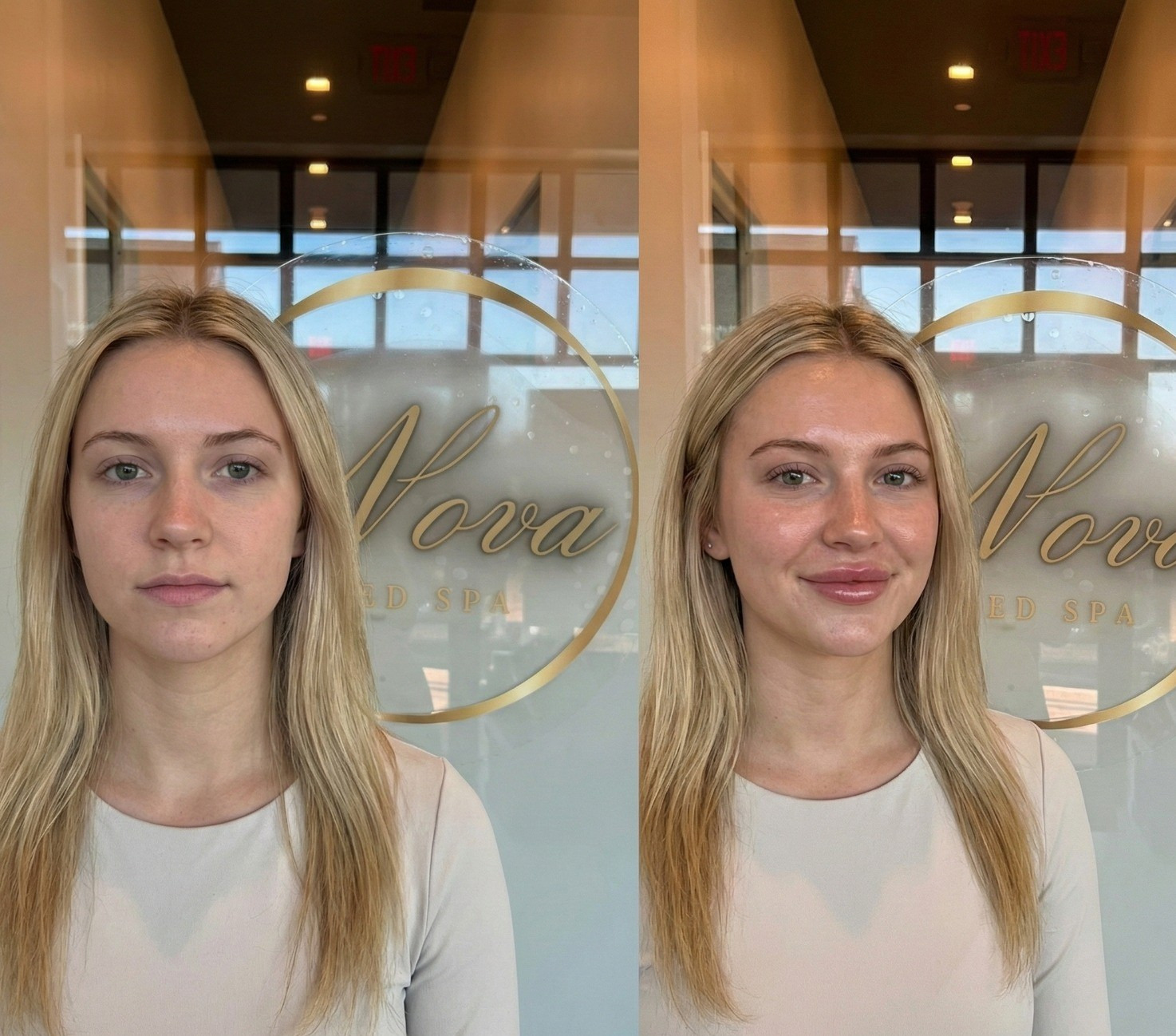 Subtle lip filler