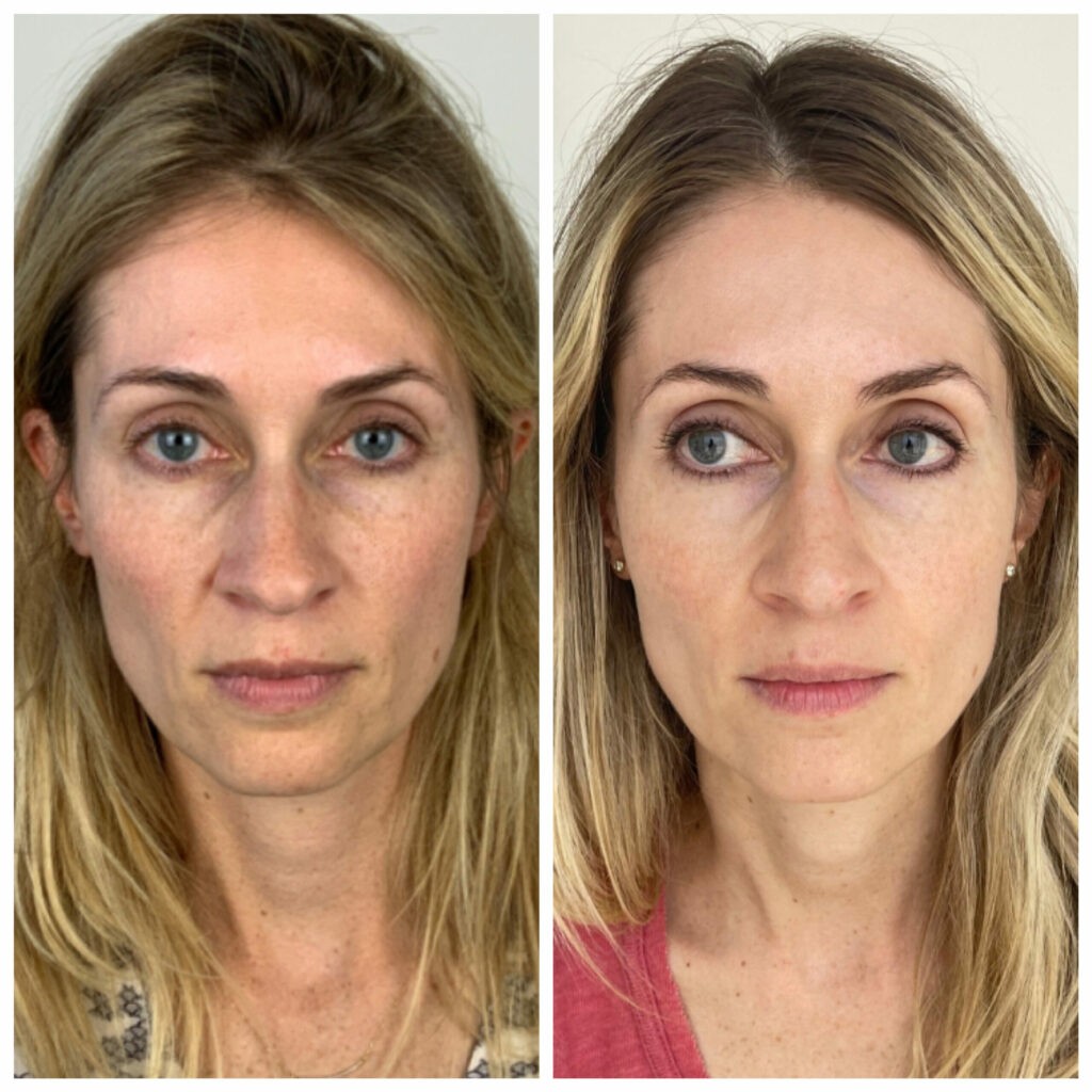 Sculptra Before and After collagen biostimulator at Nova Med Spa Plainview NY