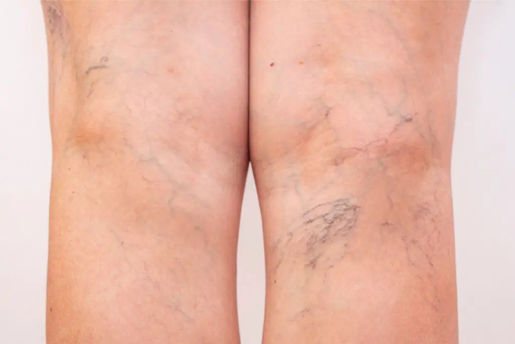 Spider vein laser treatment at Nova Med Spa Plainview NY