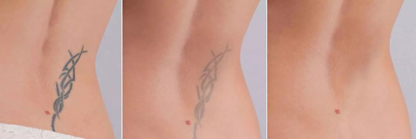 Laser Tattoo Removal Before and After at Nova Med Spa Plainview NY